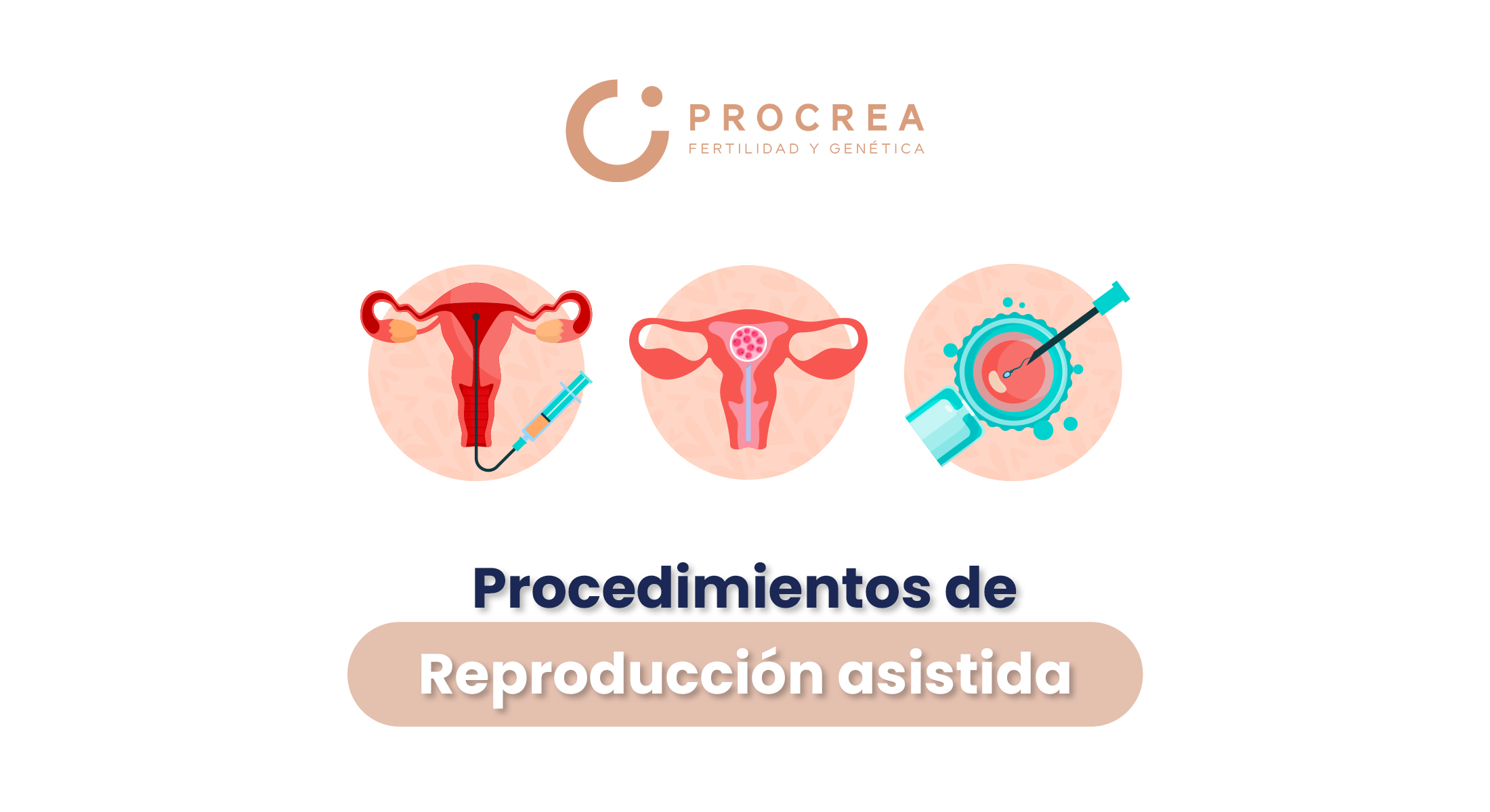 Procedimientos de alta y baja complejidad en reproducción asistida